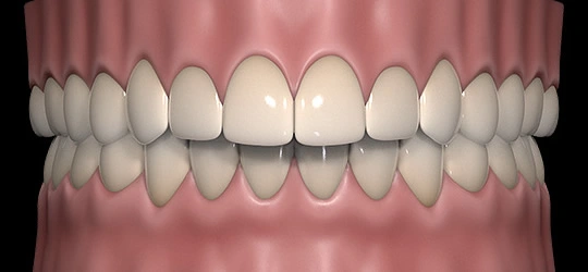 overbite 3D realistic rendering of overbite