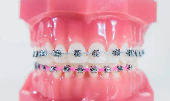 young-african-american-woman-sitting-cafe (2) why ortho - braces on prop